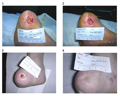 Caso clinico – ulcera con osso esposto in moncone di amputazione